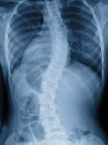 X-ray image of adult patient with severe spine curvature