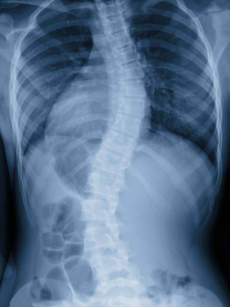 X-ray image of adult patient with severe spine curvature