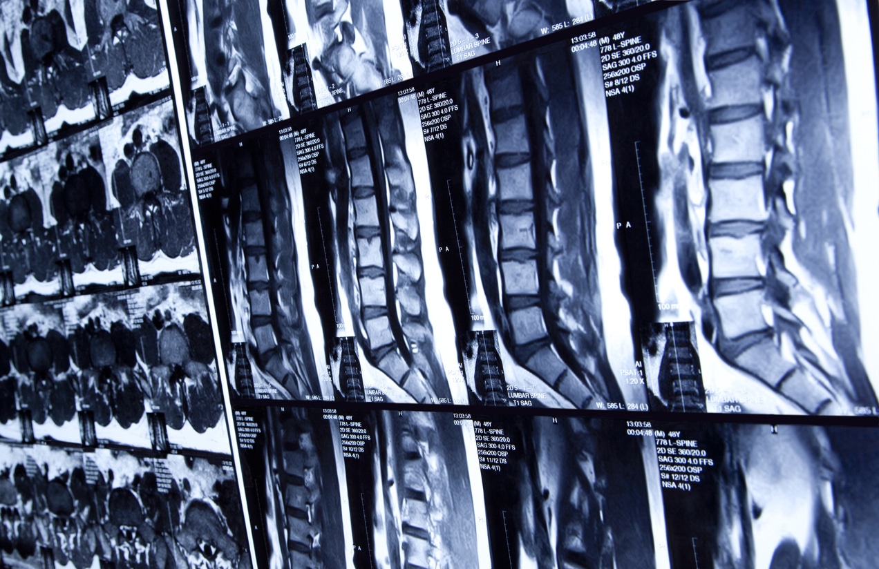 Multiple MRI scans of human spine