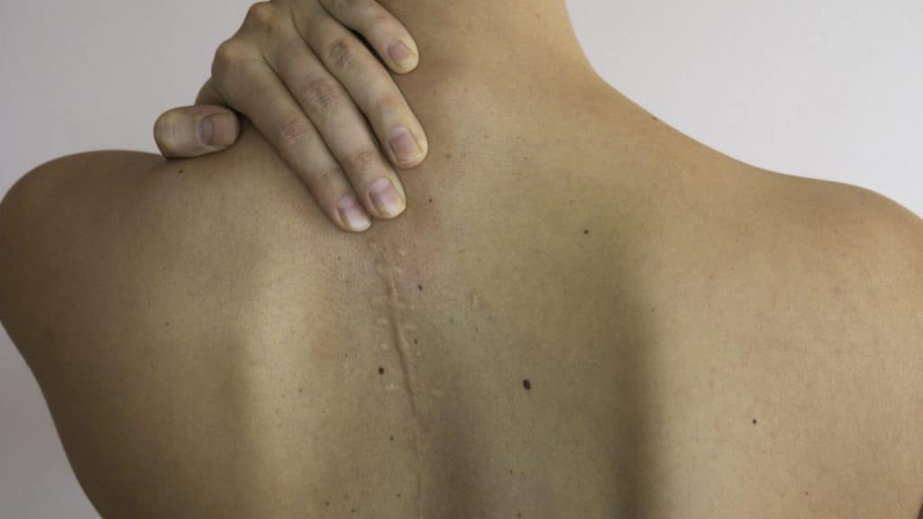 Upper back with surgery scar